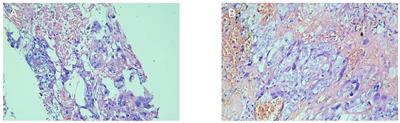 Case report: Metastatic choriocarcinoma in the second trimester of a viable pregnancy with successful delivery and outcome after chemotherapy